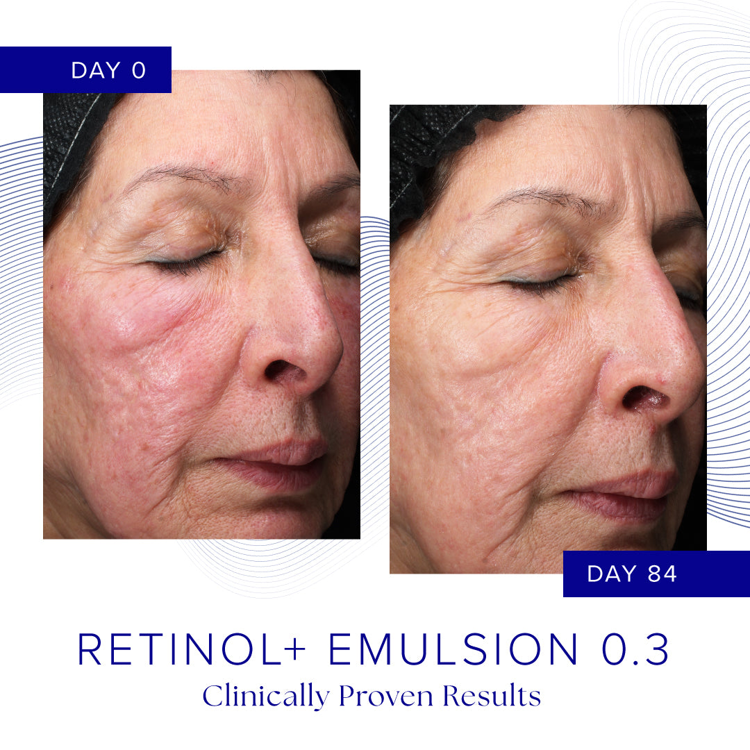 Side-by-side close-up of a woman's face showing skin texture and redness on Day 0 and Day 84 after using Retinol+ Emulsion 0.3