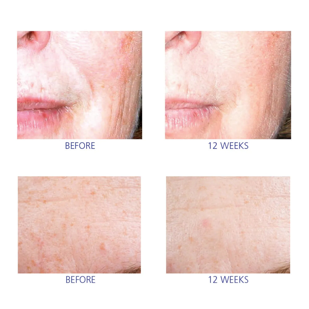 Close-up before and after photos showing skin texture and pigmentation changes over 12 weeks
