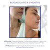 Side-by-side comparison of a woman's jawline and cheek before and after six months of skincare routine