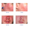 Four close-up photos showing facial redness before and after using iS Clinical Pro-Heal Serum Advance+ over one and two weeks