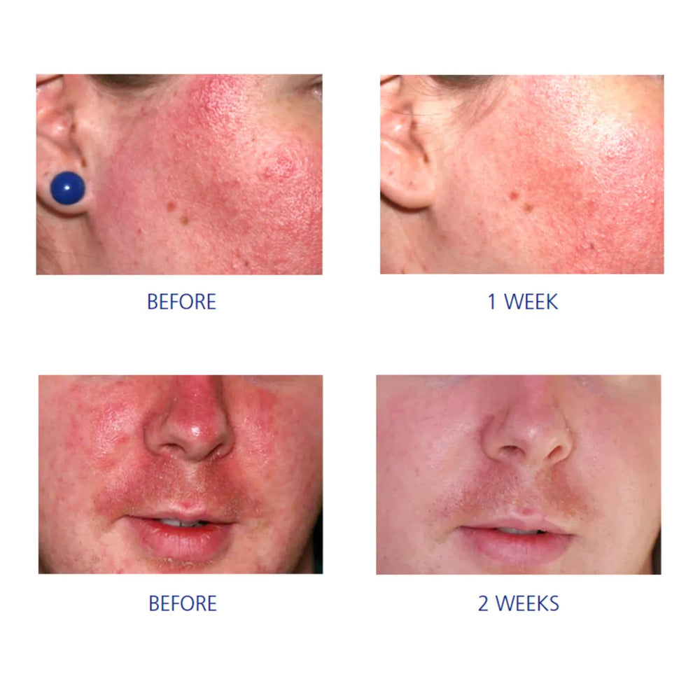 Four close-up photos showing facial redness before and after using iS Clinical Pro-Heal Serum Advance+ over one and two weeks