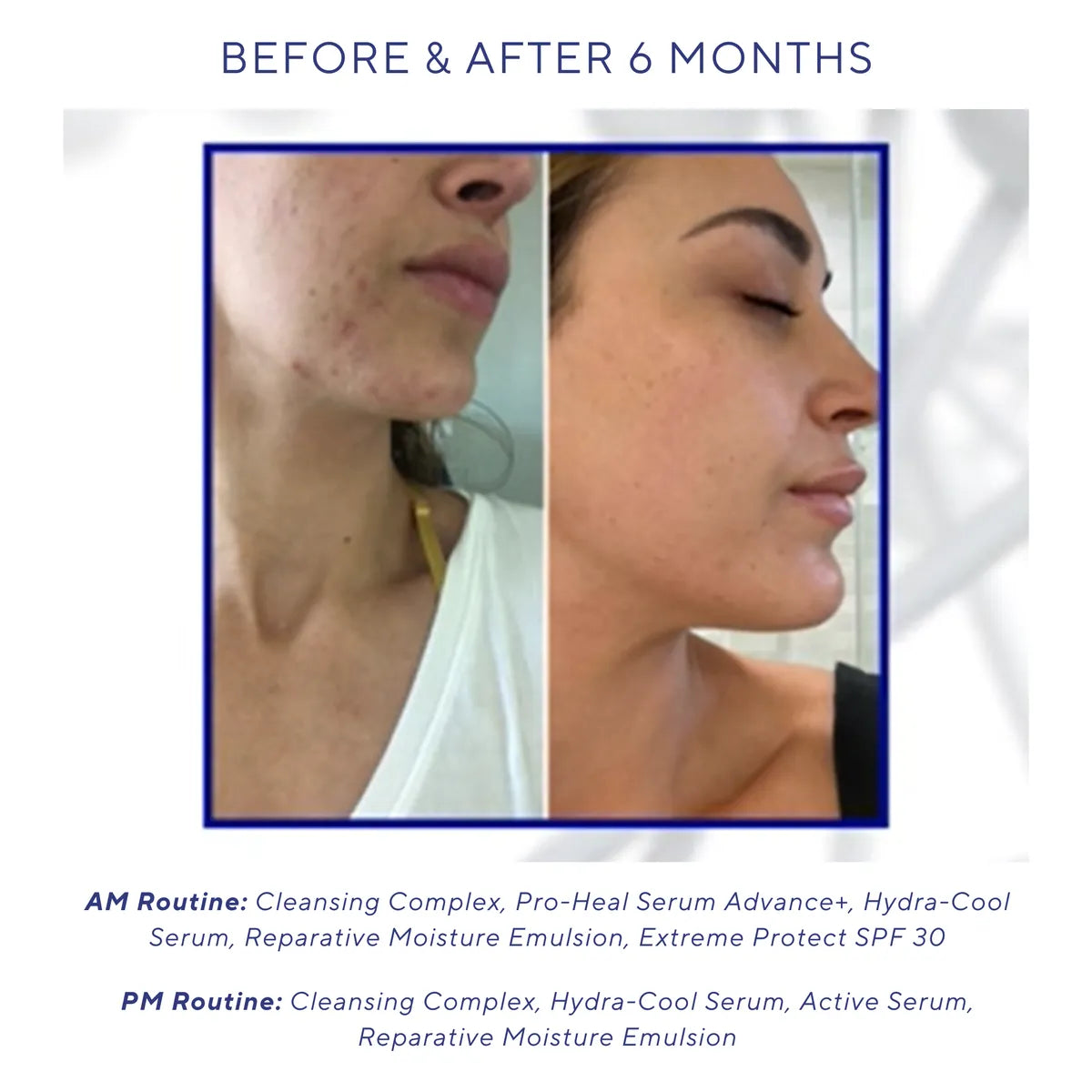 Side-by-side photos showing facial skin before and after six months of using iS Clinical Pro-Heal Serum Advance+